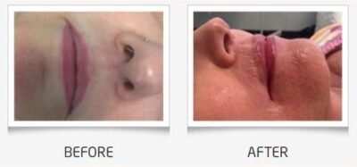 Before and after lip color permanent makeup Dallas